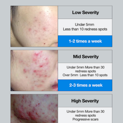 Alternative view of ACNE WASH 23 AMPOULE